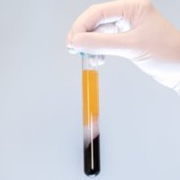 Technique PRP cheveux