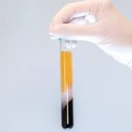 Technique PRP – Injection de plasma riche en plaquettes